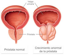 cancer_de_prostata_afecta_a_uno_de_cada_6_hombres_en_algun_momento_de_la_vida_2